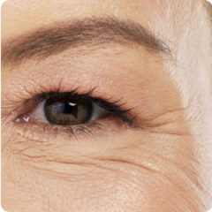 Megereszkedett, rugalmatlan bőr Megereszkedett, rugalmatlan bőr