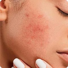 Érzékeny, irritált bőr Érzékeny, irritált bőr